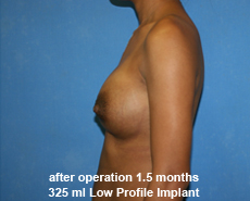 plastic-surgery-breast-augmentation